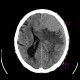 Brain tumour, meningioma: CT - Computed tomography